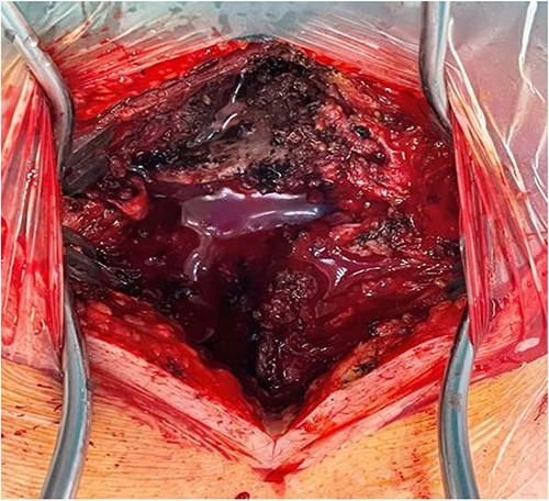 Intraoperative finding: C6/C7 dislocation.