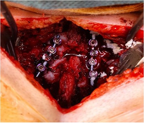 Intraoperative finding after repositioning and stabilization: screws placed into the C5-C7 massae laterales and the T1 pedicles; fixation performed with titanium rods.