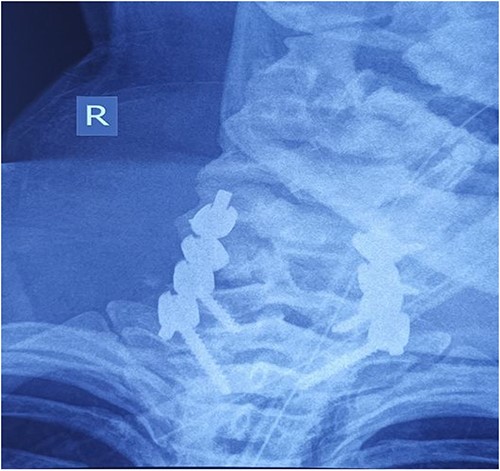 Cervical spine X-ray postoperatively – AP view: properly positioned osteosynthesis material.