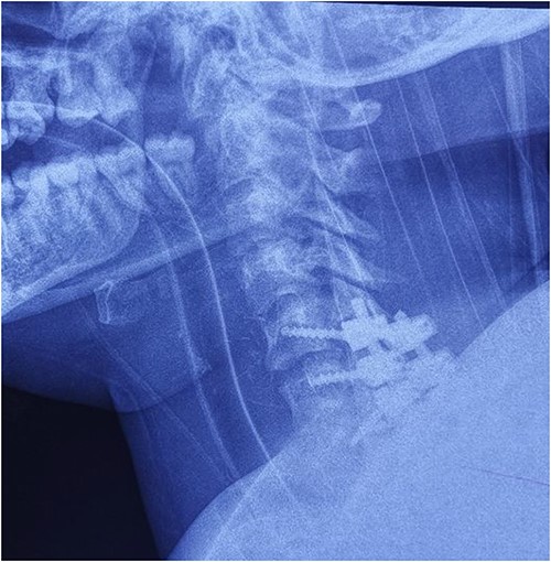 Cervical spine X-ray postoperatively – lateral view: properly positioned osteosynthesis material.