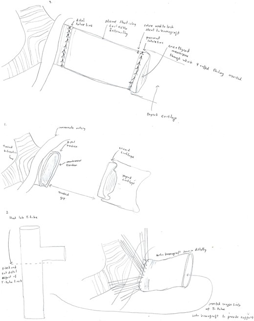 Diagram displaying the anatomy of the patient’s dehiscence at the time of her tracheal replacement using the aortic allograft (1), and the method of stent and homograft placement (2–3).