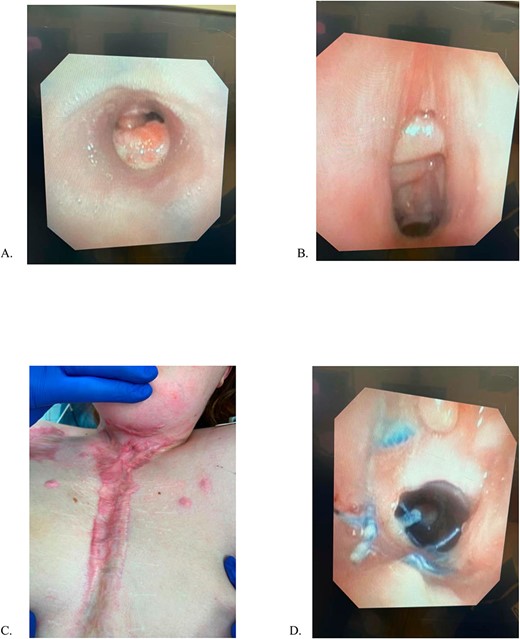 (A) Mid-tracheal stent, (B) Subglottic space, previous tracheostomy site, (C) Sternal incision, (D) Proximal Anastomosis. All images were obtained 5/6/23, 15 months after aortic homograft reconstruction.