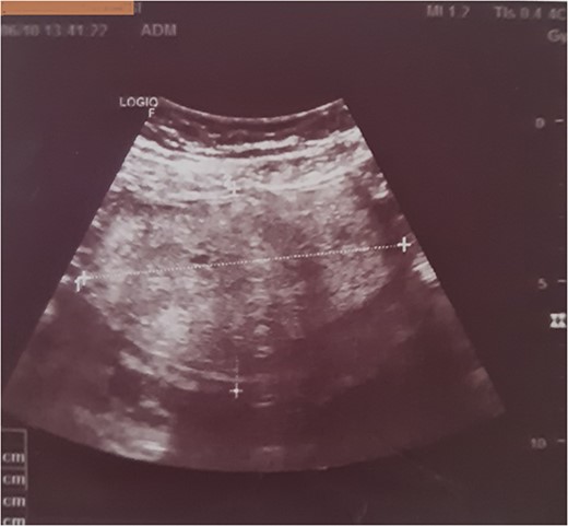 Ultrasound showing an oval, well-limited left ovarian mass, with regular contours, and a heterogeneous, hyperechoic echostructure and cystic areas.