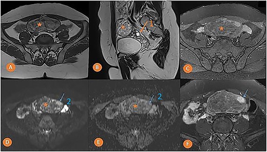 Pelvic MRI in axial T1 (A), sagittal T2 (B), axial T1 FS (C), axial DWI (D) with ADC mapping (E), and axial T1 injected (F) slices showing a median pelvic mass (star) lateralized on the left in contact with the homolateral ovary (arrow 1) with heterogeneous signal, mostly hyper intense in T1 and T2. It fades after removal of the fat and is not diffusion-restrictive except for a small nodular area on the left anterolateral side (arrow 2) which takes on strong contrast after injection of the gadolinium chelate.