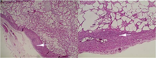 Lipoleiomyoma: proliferation consisting of a smooth muscle component visible in the periphery (arrow) and mature adipocytes separated by fibrous trabeculae. Haematoxylin and eosin; ×10.