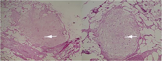 Immature or mature cartilage nodules identified in conjunction with adipocytes and smooth muscle bundles. Haematoxylin and eosin; ×20.