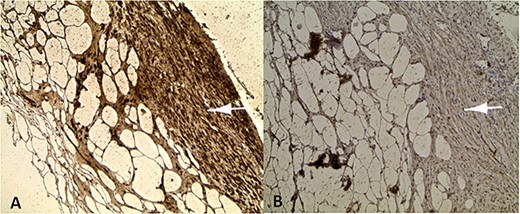 Positive labelling of smooth muscle cells with the muscle markers Desmine (A) and Hcaldesmon (B).
