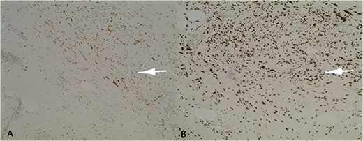 Positive nuclear labelling of smooth muscle cells with oestrogen receptor (ER) (A) and progesterone receptor (PR) (B).