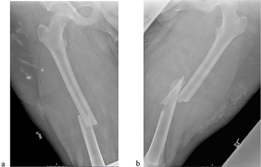 (a) Right femur fracture (OTA 32-A3). (b) Left femur fracture (OTA 32-B2).