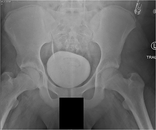 AP pelvis radiograph, modified Oxford Grade 25.