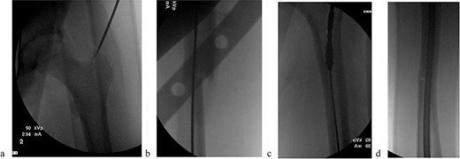 (a) Obtaining greater trochanteric entry starting point. (b) Fracture reduction with the “F” tool and passed ball-tipped guidewire. (c) Sequentially reaming with the RIA. (d) Maintained fracture reduction with implanted rigid femur rod.
