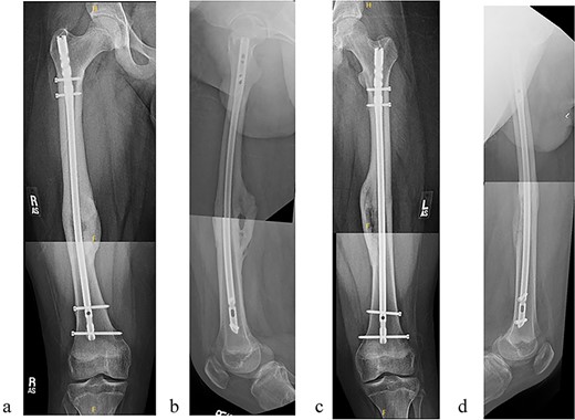 (a) Right femur AP radiograph. (b) Right femur lateral radiograph. (c) Left femur AP radiograph. (d) Left femur lateral radiograph.