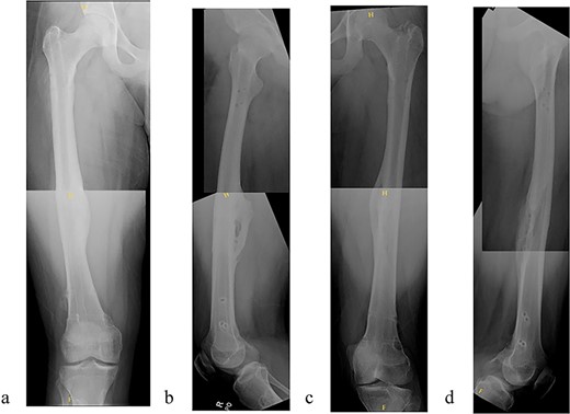 (a) Right femur AP radiograph after implant removal. (b) Right femur lateral radiograph after implant removal. (c) Left femur AP radiograph after implant removal. (d) Left femur lateral radiograph after implant removal.