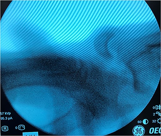 Initial presentation of the right dorsal lunate dislocation.
