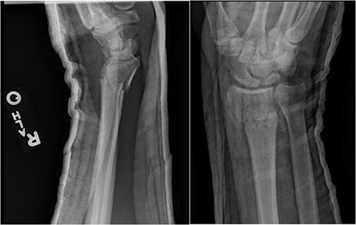 Anteroposterior (AP) and lateral views demonstrating the right distal radius and perilunate dislocation after closed reduction in the trauma bay.
