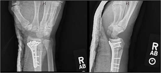 AP and lateral views immediately postop demonstrating right distal radius fixation and PRC.