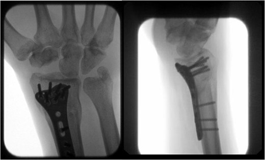AP and lateral views at 7-month follow-up demonstrating a healed right distal radius fracture without arthrosis at the new radiocarpal joint.