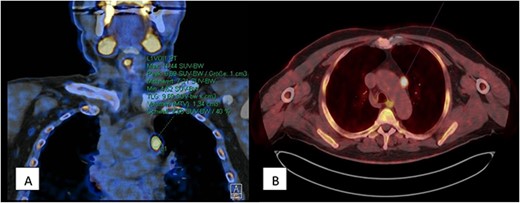 567 MBq C-11-Methionin (A) coronary view of upper mediastinum, (B) axial view with oval lesion with increased amino acid metabolism left of the aortic arch.