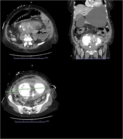 Abdominopelvic CT findings of a large multifibroid uterus with amorphous central calcification associated with a small bowel obstruction.