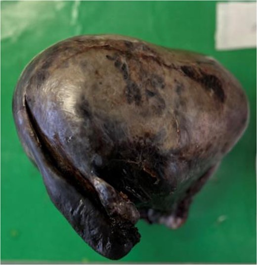 Macroscopic photo of the uterus demonstrating haemorrhage and necrosis (discoloration), in keeping with infarction.