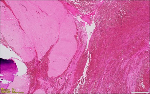 Hyalinized and calcified leiomyoma with adjacent haemorrhagic infarction of the uterine wall, in keeping with torsion.
