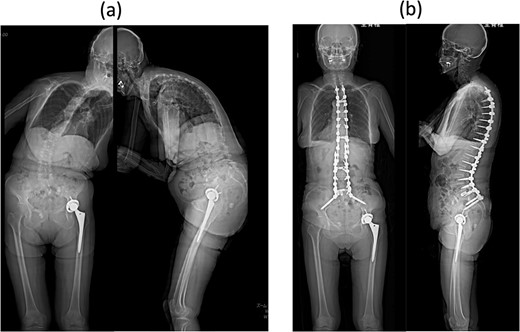 Standing whole-spine anteroposterior and lateral radiographs (a) preoperative and (b) after the first surgery.