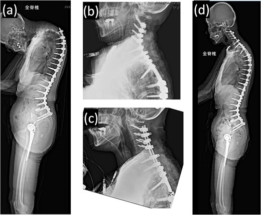 (a) Standing whole-spine radiographs 16 months after the first surgery, showing features of dropped head syndrome associated with proximal junctional failure; lateral radiographs immediately after (b) the second and (c) third surgeries; (d) standing whole-spine radiographs 16 months after the third surgery.