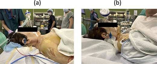 Lateral view of neck posture (a) before and (b) after the third surgery.