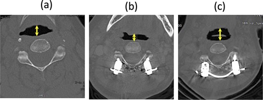 CT axial image at the C2 level in a supine position; (a) before the second surgery, (b) after the second surgery, and (c) after the third surgery; the arrow shows the pharyngeal diameter.