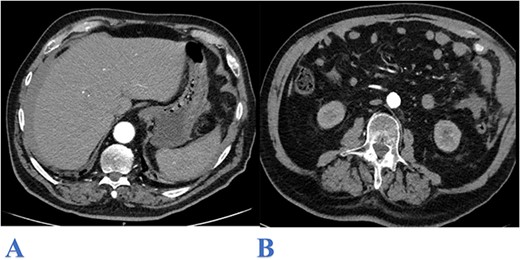 Axial CT abdomen image (arterial phase) showing: bilateral subphrenic hemoperitoneum (A) and contrast extravasation from the upper left lateral omentum (B).