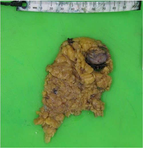 Macroscopic resected specimen of Omentum with bleeding pedicle.