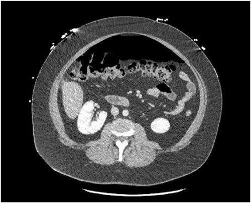 Axial CT demonstrating moderate amount of peritoneum.
