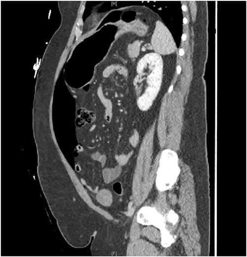 Sagittal CT view demonstrating pneumoperitoneum.
