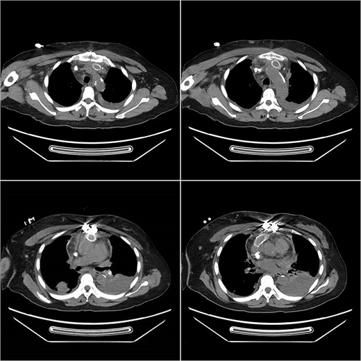 Postoperative computed tomography angiography (CTA) showed no contrast agent leakage in the artificial blood vessel.