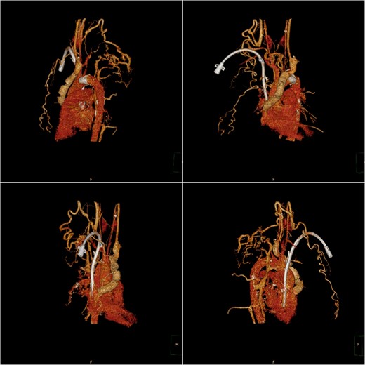 Postoperative computed tomography (CT) three-dimensional reconstruction shows the artificial blood vessel and tunneled cuffed catheter deformation.
