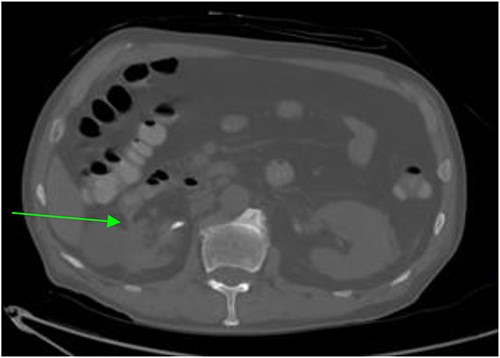 CT abdomen and pelvis revealing a right sided renal-duodenal fistulous connection.