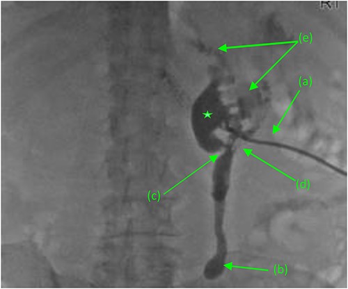 Antegrade pyelogram (prone position) revealing (a) right percutaneous nephrostomy tube (PCN), following the failed ureteral stent placement due to a distal ureteral stricture with subsequent (b) right sided hydroureter and abrupt cutoff. (*) Right sided hydronephrosis, secondary to (c) a second, more proximal ureteral stricture with a (d) frank fistulous connection tracking between the proximal ureter and duodenum. (e) Suspected retrograde leakage of contrast media from the right renal pelvis into the duodenum.