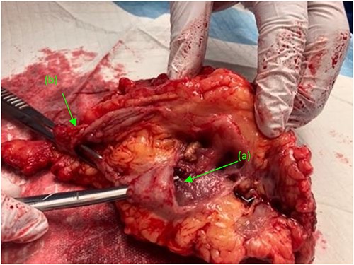 Right kidney, status post nephrectomy, transected at the renal hilum. (a) First fistulous tract exiting the renal pelvis. (b) Second fistulous tract extending from its origin point off the proximal ureter and branching just distal to the ureters entry at the renal pelvis.