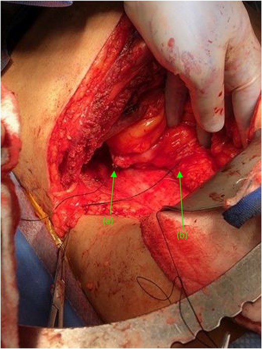 Two suture tagged fistulas status post fistulectomy and debridement to their base, entering the (a) second and (b) third portions of the duodenum, status post nephrectomy.