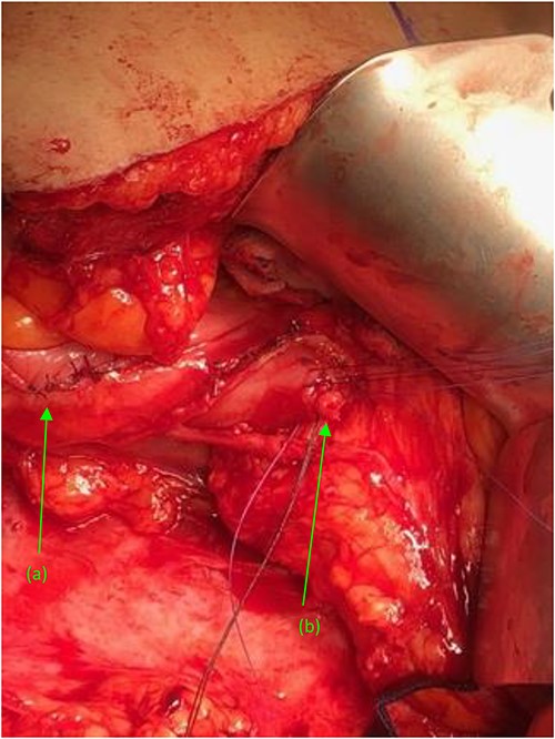 (a) Repaired duodenal defect where the (first) fistula previously entered the second portion of the duodenum, status post fistulectomy and stump closure. (b) Second fistula indicated by suture tags status fistulectomy and trimming to the base of the fistulous tract, near its entry point at the third portion of the duodenum.