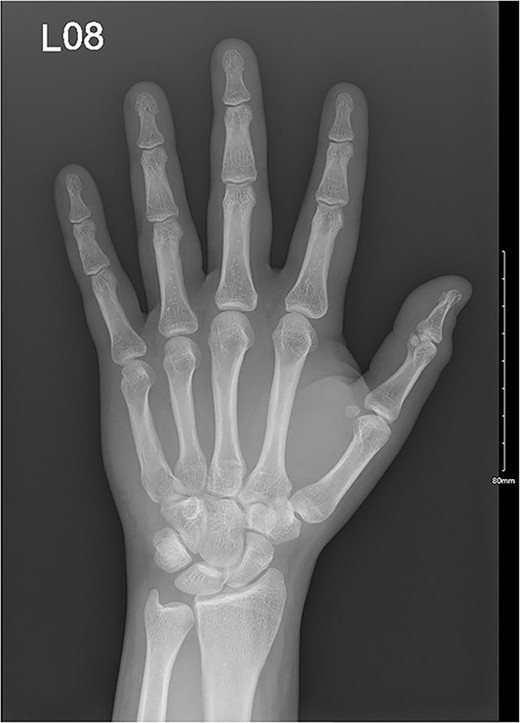 A comminuted slightly displaced fracture of the tip of the left fifth distal phalanx.