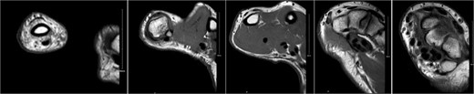 Complete tear of ulnar collateral ligament with significant proximal retraction.