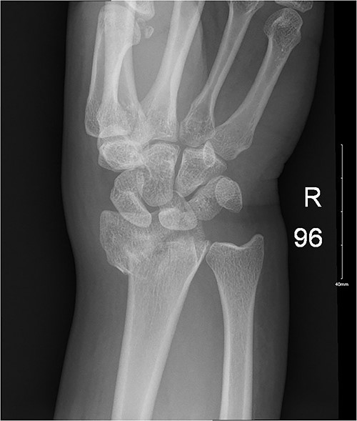 Impacted comminuted fracture of the distal radius.