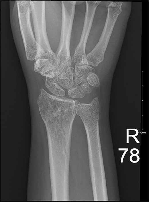 Ongoing healing is seen in the distal radius fracture. The fracture line is barely visible.
