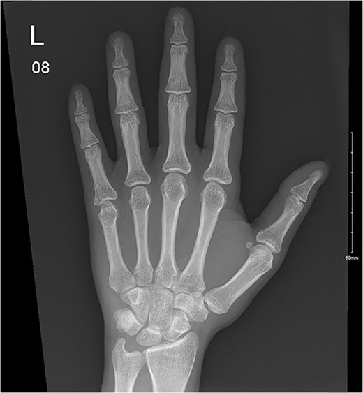A minimally displaced fracture at the base of proximal fifth phalanx extending into the articular surface.