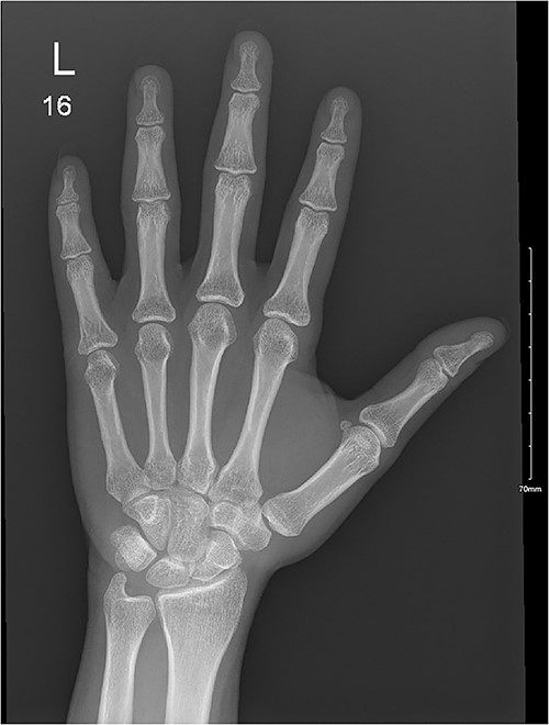 Fracture at the fifth proximal phalanx with ongoing healing.