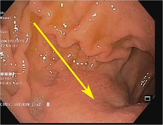 Endoscopic image showing the gastric antrum: loss of rugosity, erythema, and extramucosal bulge (arrow).
