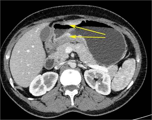 CT scan of the abdomen showing gastric wall thickening at the level of the pyloric antrum (yellow arrows).