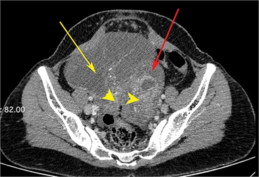 CT scan of the abdomen showing right ovarian cyst (yellow arrow), left ovarian cyst (red arrow) with solid elements within (arrow heads).