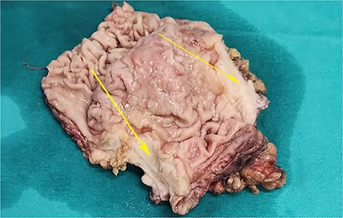 Postoperative specimen of the stomach showing intramural tumour at the pyloric antrum (arrow).